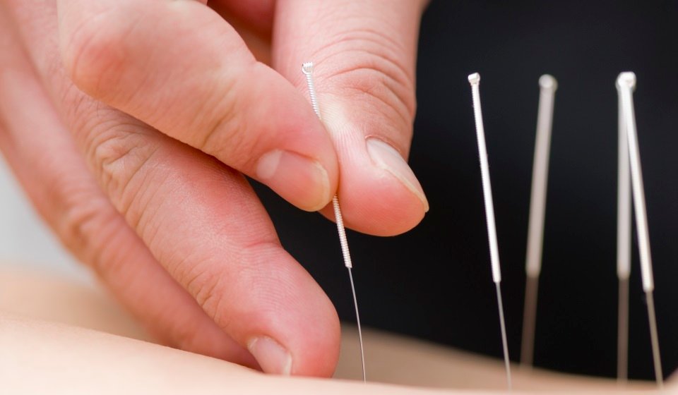 Acupuncture 